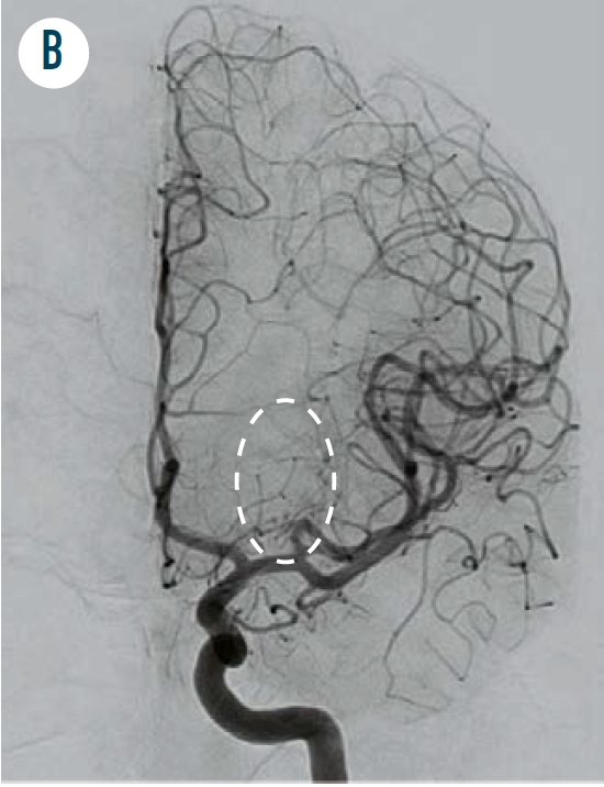 FIGURE 4B. The patient was first treated with trans-arterial embolization and then with stereotactic radiosurgery. Follow-up angiogram at 3 years demonstrates no residual AVM (in the oval area marked by the dash) and no early draining vein (white arrow area in Figure 4A.) (Figure author provided)