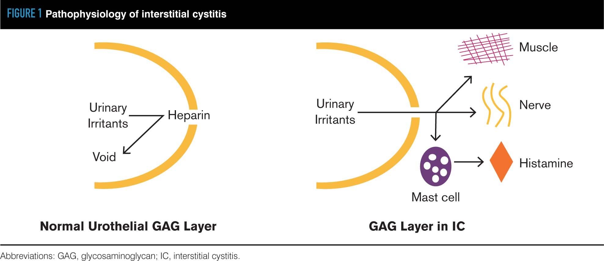 Interstitial cystitis: Simplified diagnosis and treatment | Contemporary OB/GYN Interstitial cystitis: Simplified diagnosis and treatment | Contemporary OB/GYN