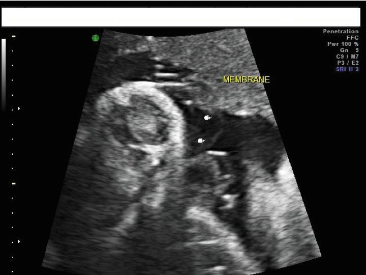 Target Sign Fetus Ultrasound images: Fetal anomalies in multi-fetal gestations