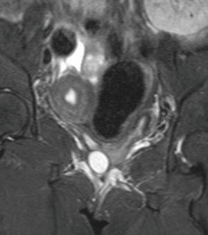 Uterine anomalies in pregnancy