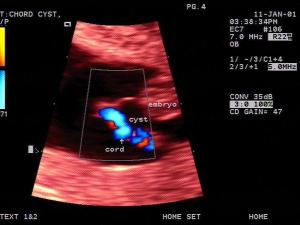TRV Embryo (Transvaginal) Umbilical Cord Cyst