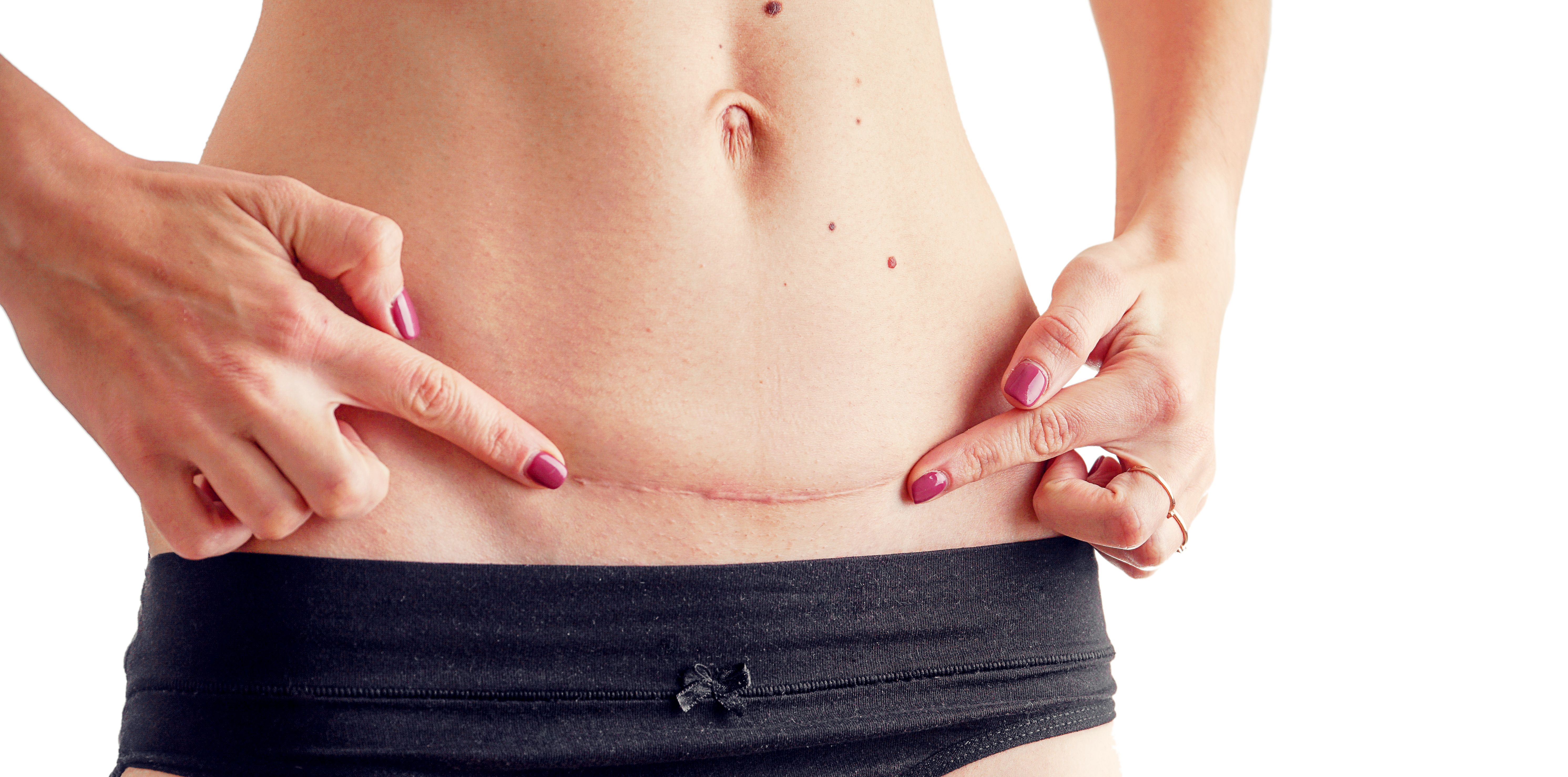 Endometriosis in Caesarean section incision scar