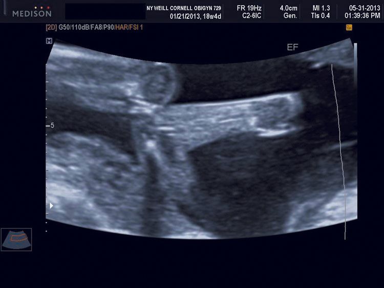 Ultrasounds images: Fetal anomalies of the first and second trimesters ...