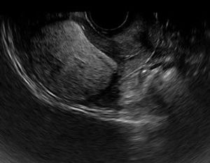 Lipoleiomyoma