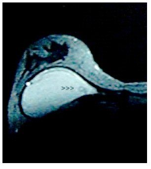 Evaluation of the Rupture of Silicone Breast Implants by Mammography