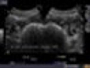 Incidental Finding on Routine Ultrasound Imaging of the Pelvis