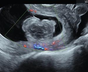An imaging approach to early pregnancy failure