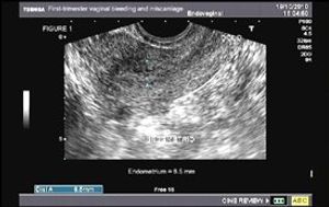 Retained Products of Conception