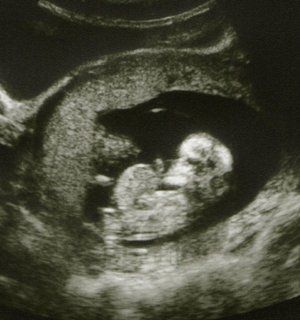 Omphalocele or Gastroschisis?