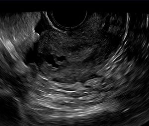 Adenomyosis