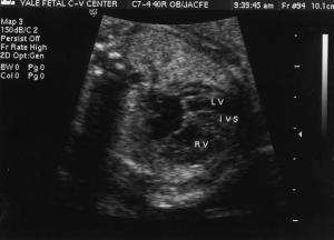 Fetal Cardiac Anomalies