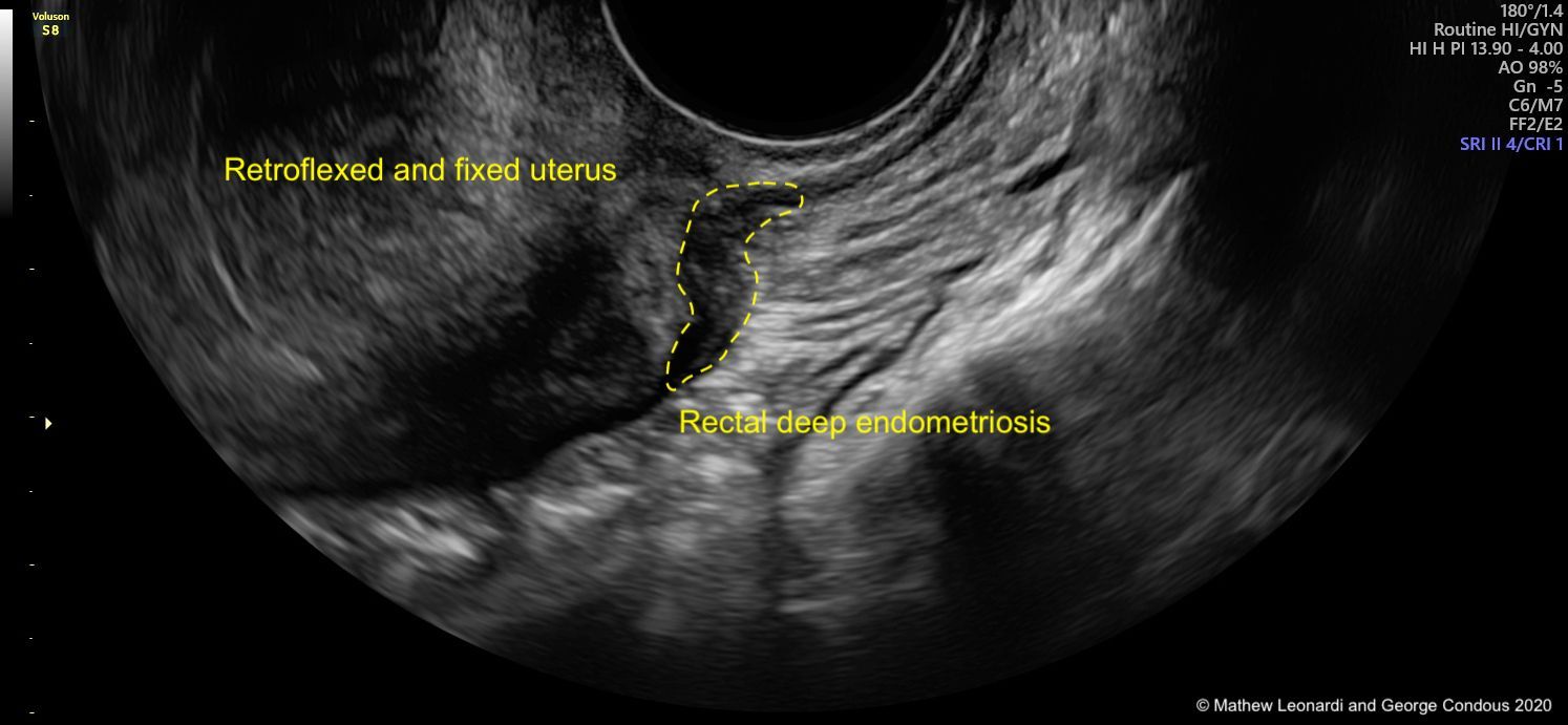 Noninvasive Ultrasound Diagnosis Of Endometriosis Contemporary Ob Gyn
