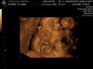 Macroglossia 3D Face