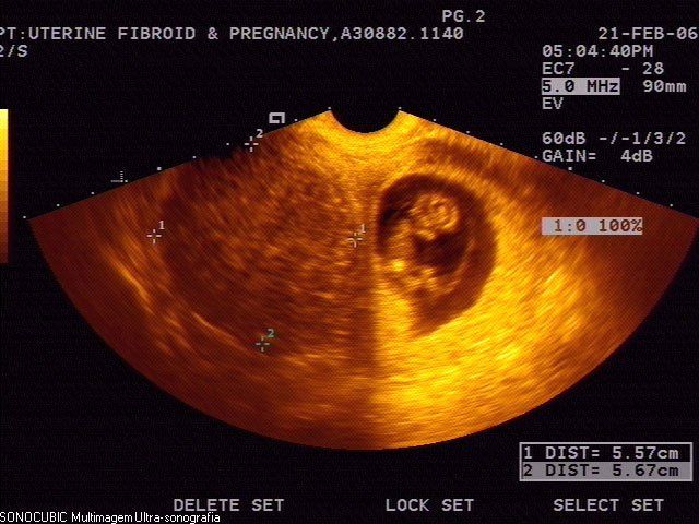 glp 1 fibroids Uterine fibroid (right lateral wall) Nine (9) weeks and 4 days gestation