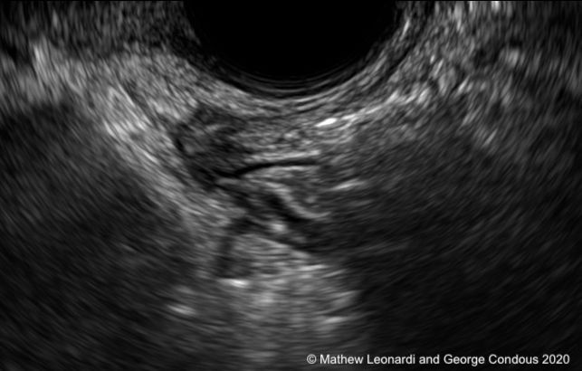 Noninvasive ultrasound diagnosis of endometriosis | Contemporary OB/GYN