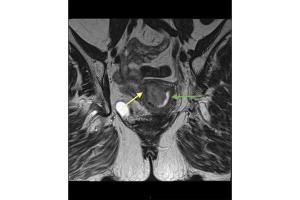 The value of GBCA in MRI images