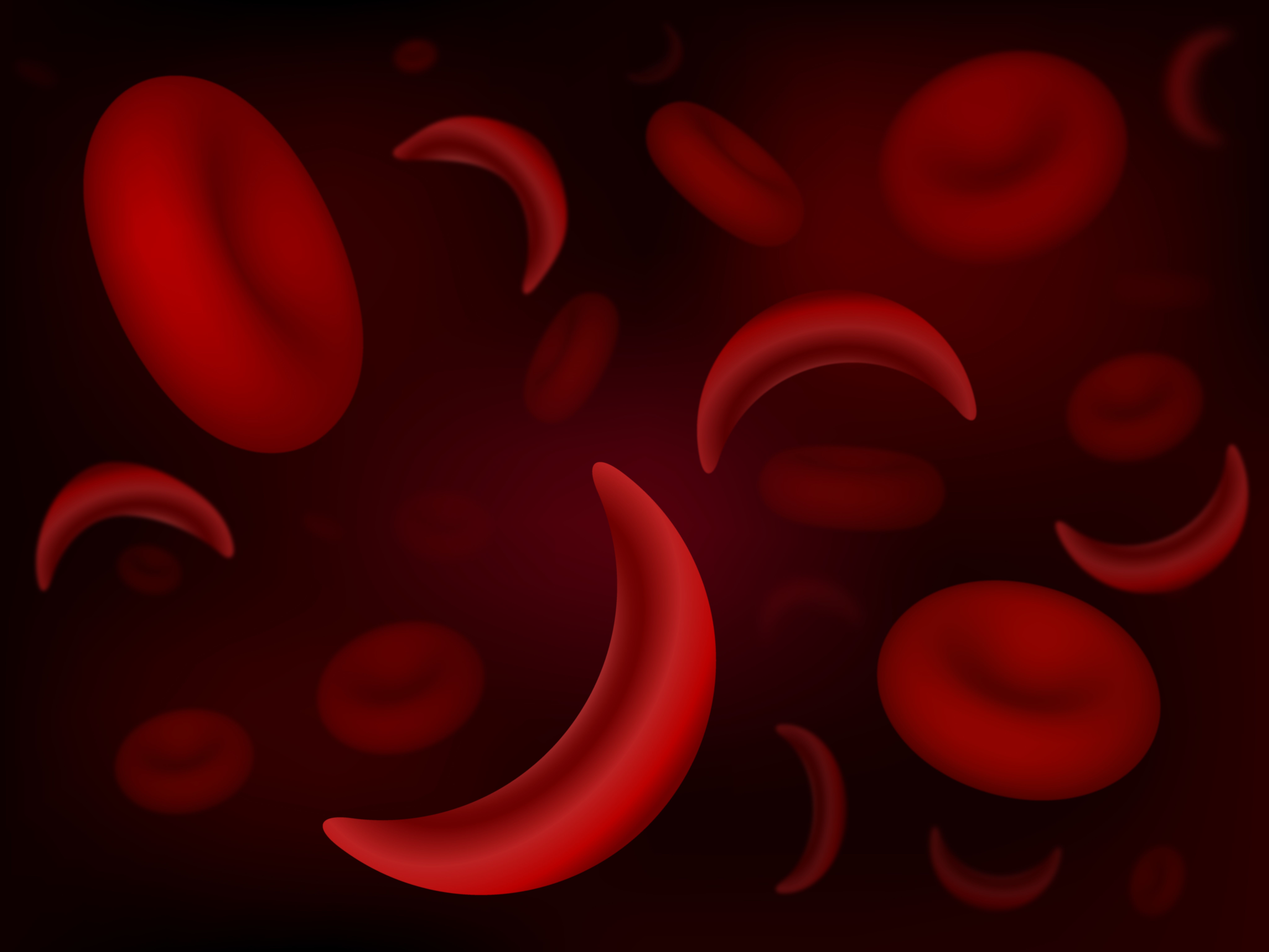 Sickle Cell