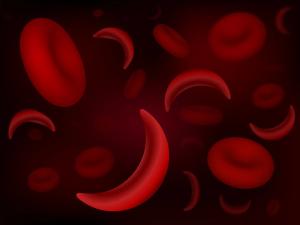 Sickle Cell