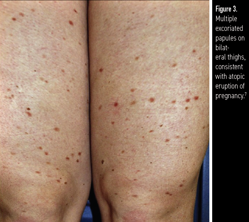 Dermatoses Of Pregnancy