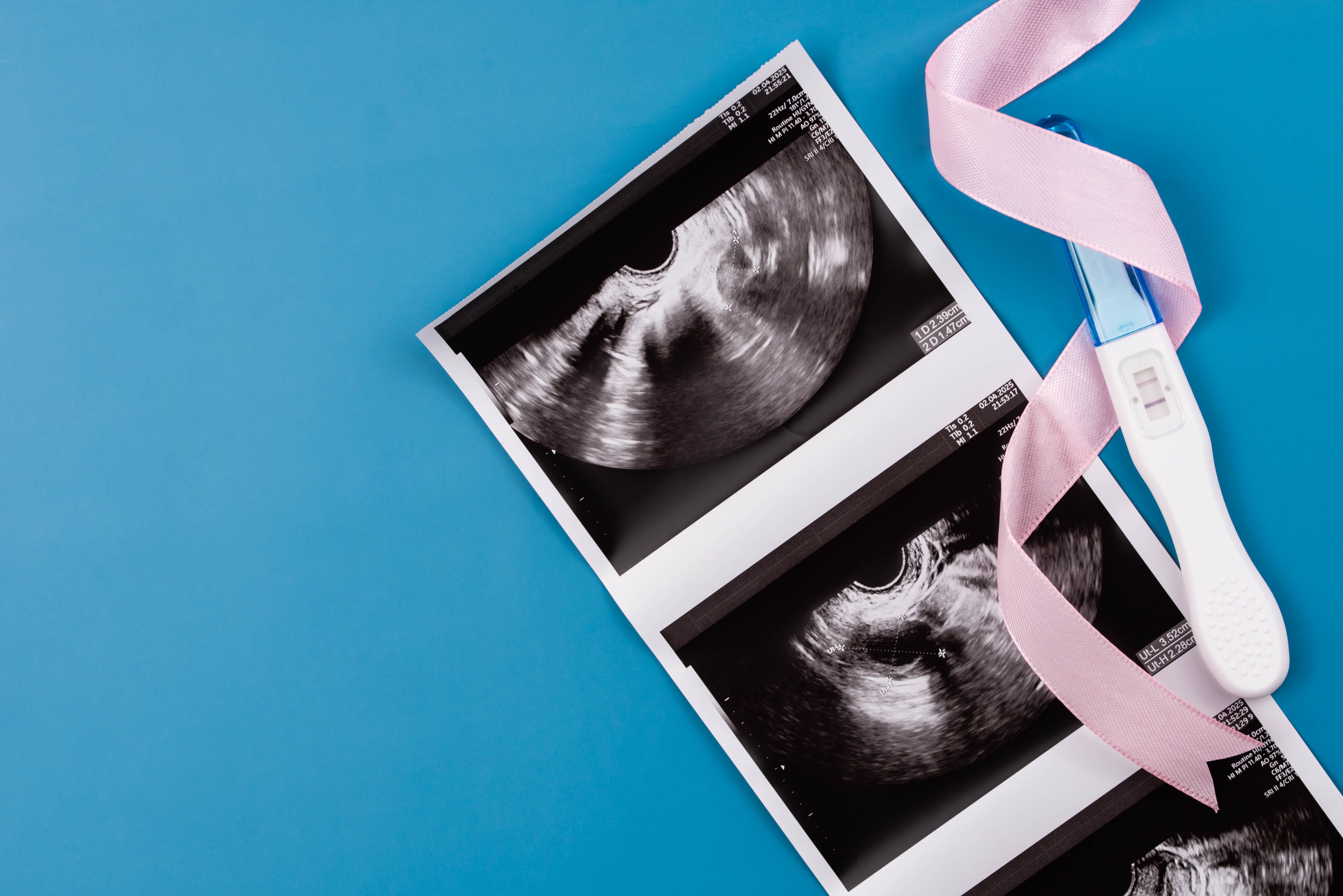 Racial disparities found in severe maternal morbidity after cesarean delivery Racial disparities found in severe maternal morbidity after cesarean delivery