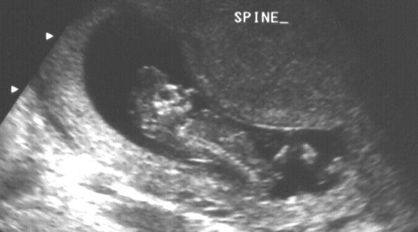 Exencephaly Exencephaly – Anencephaly Sequence and its Sonographic Features
