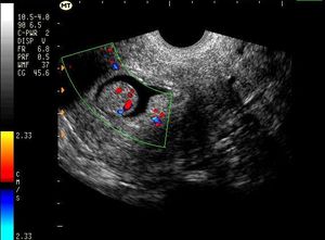 SAG Uterus (Transvaginal) Endometrial Polyp