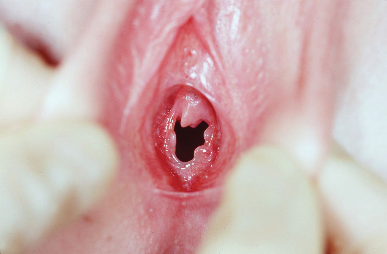 Examination of the vulva of a prepubertal child. 