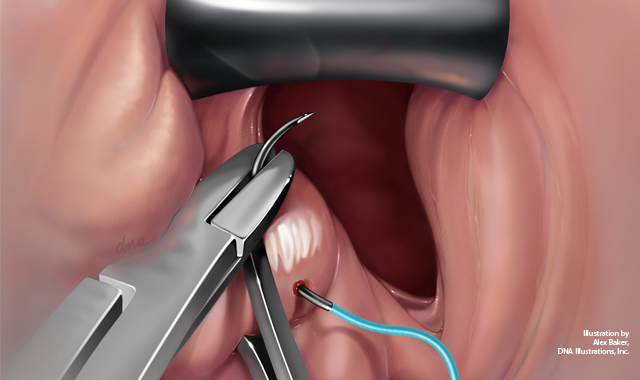 vaginal lubrication after hysterectomy Exploring sex and menopause after hysterectomy main image 1