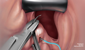 Did vaginal hysterectomy result in iatrogenic injuries?