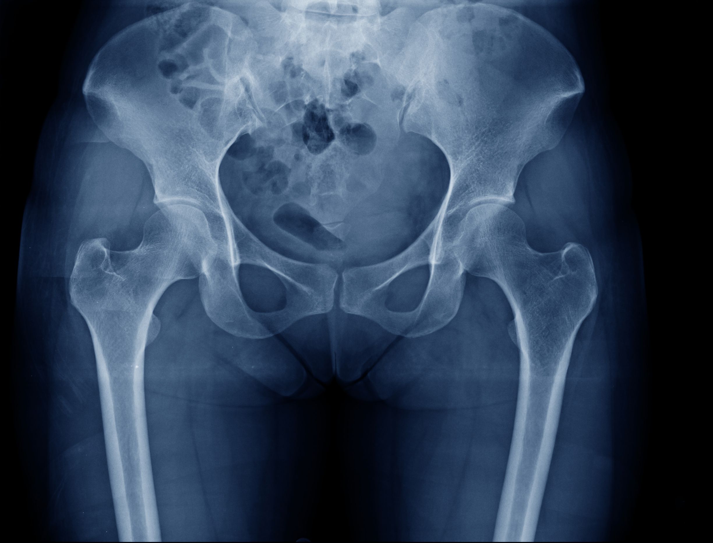 Surgical anatomy of the frozen pelvis