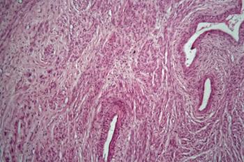 Cells of a human uterus with uterine fibroids under the microscope.