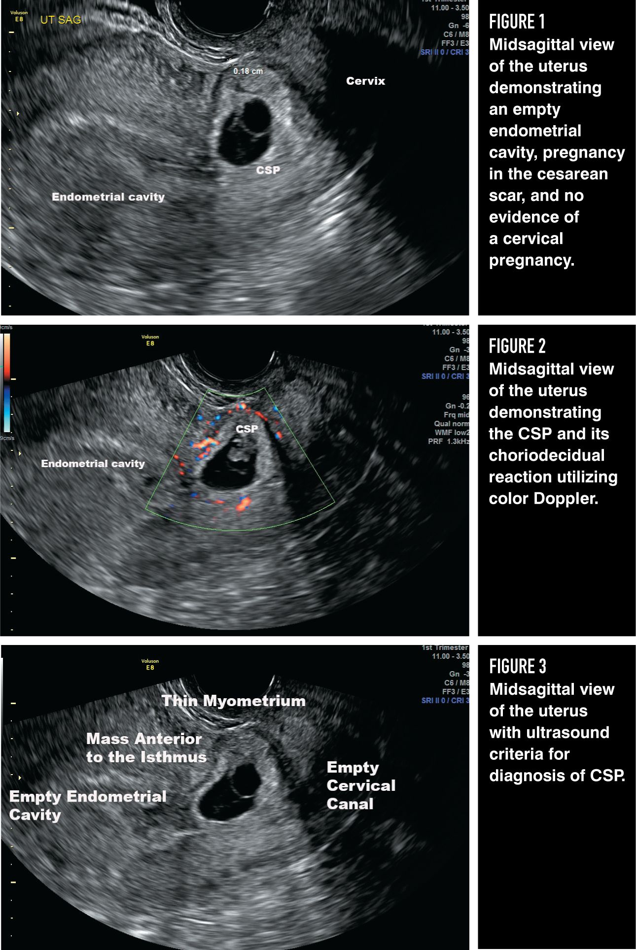 How to diagnose and treat cesarean scar pregnancy