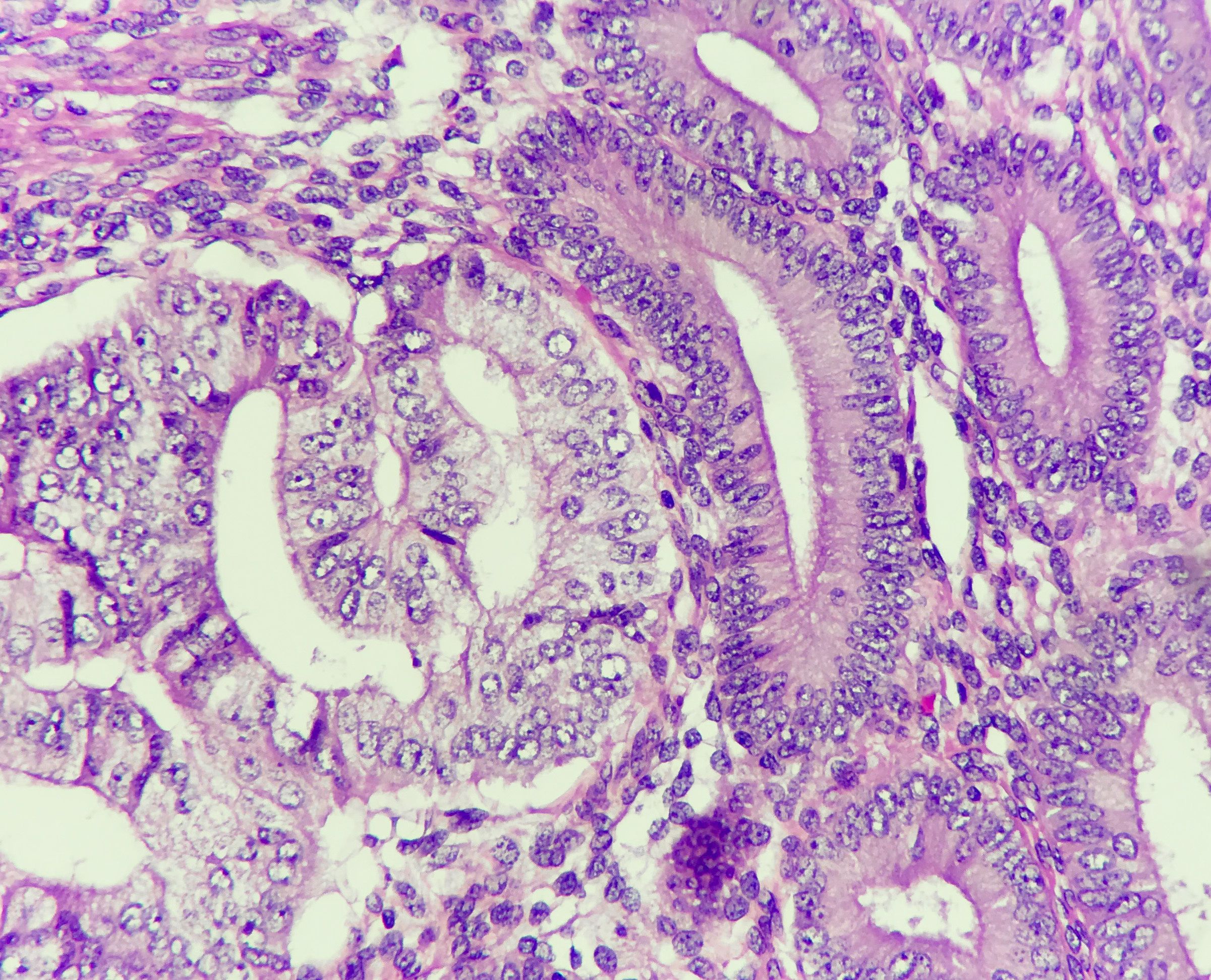 Molecular profiling reduces need for radiotherapy in endometrial cancer Molecular profiling reduces need for radiotherapy in endometrial cancer
