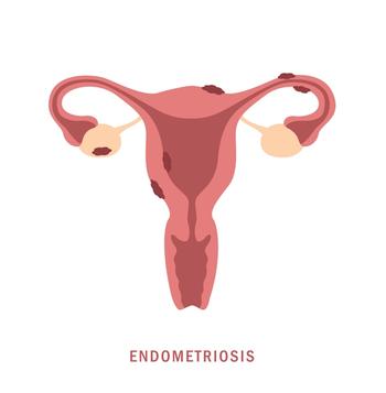 Molecule shows promise for MASH, endometriosis, and other chronic diseases |  Image Credit: © krissikunterbunt - © krissikunterbunt - stock.adobe.com.