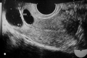 SAG Uterus (Transvaginal) Nabothian Cysts