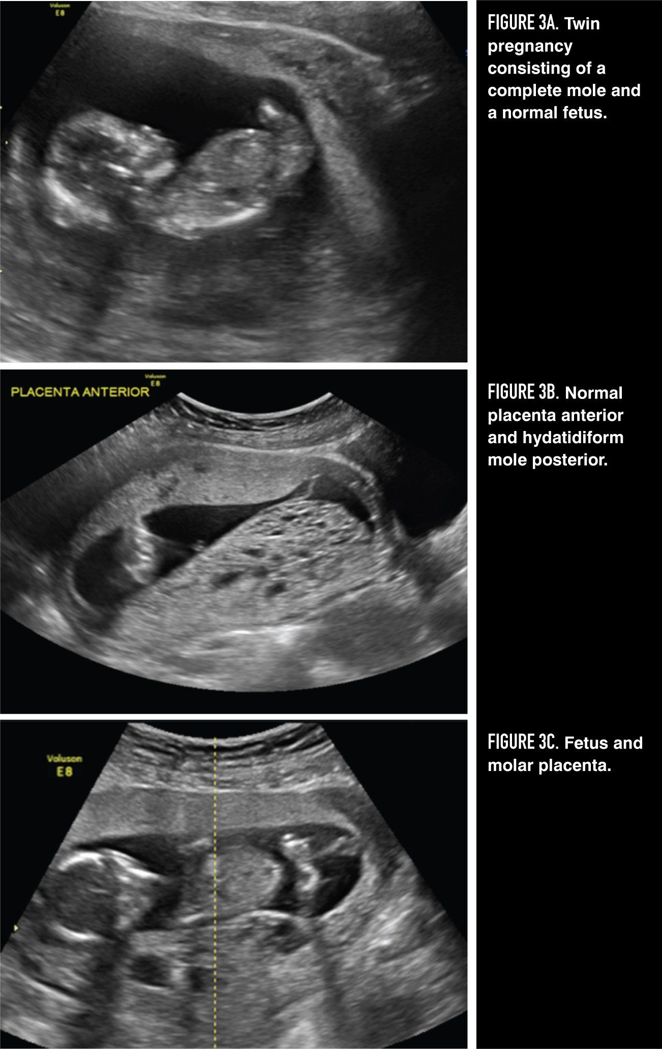 case presentation of molar pregnancy case presentation of molar pregnancy