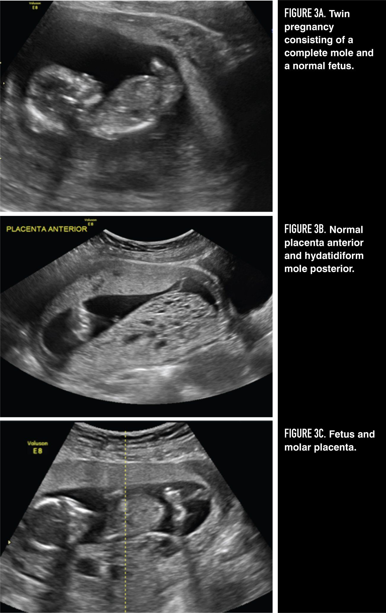 case presentation of molar pregnancy