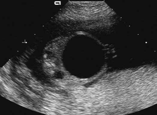 fetal abdomen at 16+5 weeks pregnancy, showing fetal megavesica