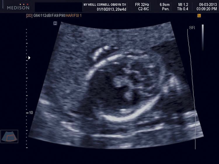 Second trimester holoprosencephaly