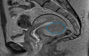 Adenomyosis and its impact on fertility