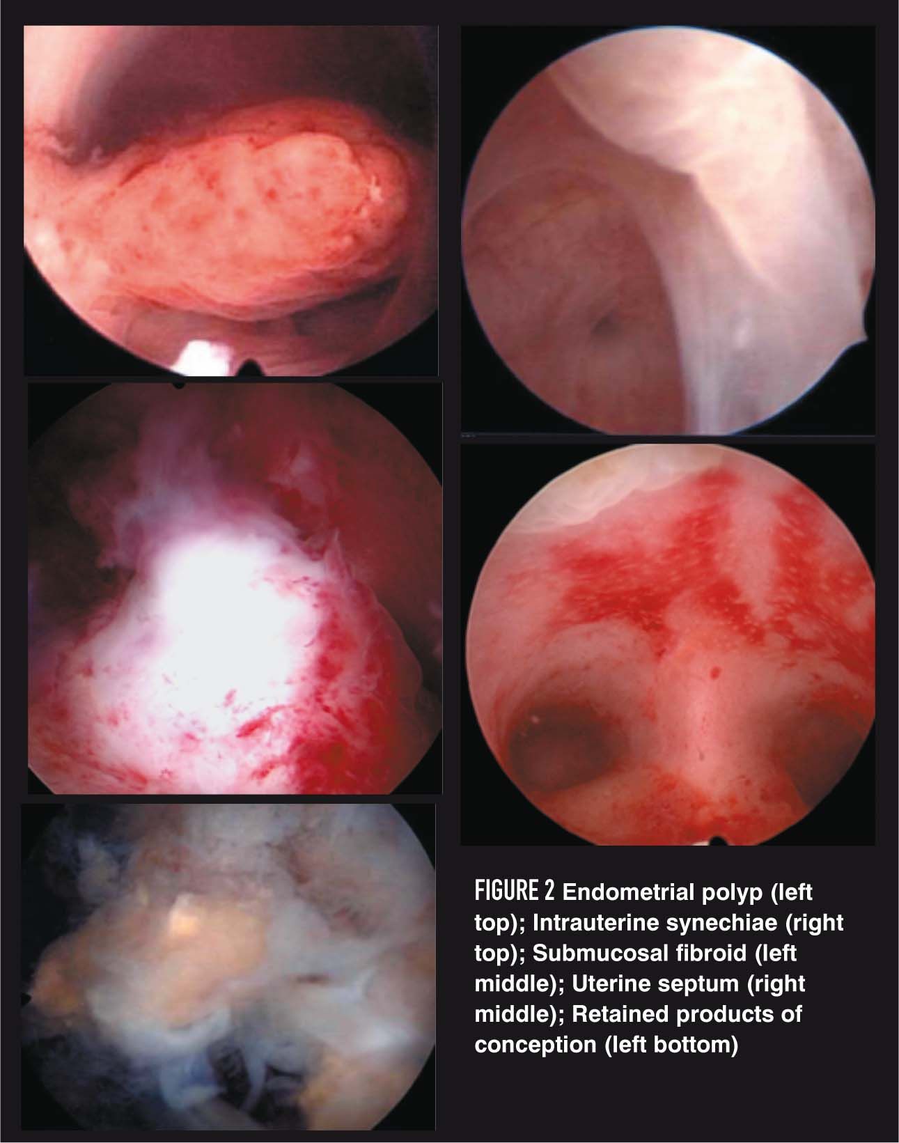 Why You Should Be Performing Office Hysteroscopy Now