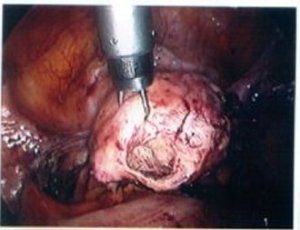 Morcellation: Doctors Need Data, Not Rhetoric