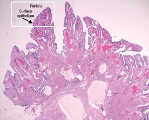 Clues to the origins of ovarian cancer