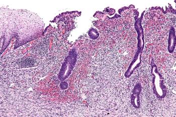 Uterine cervix with endometriosis