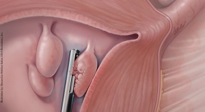 Endometrial polyps: In-office management