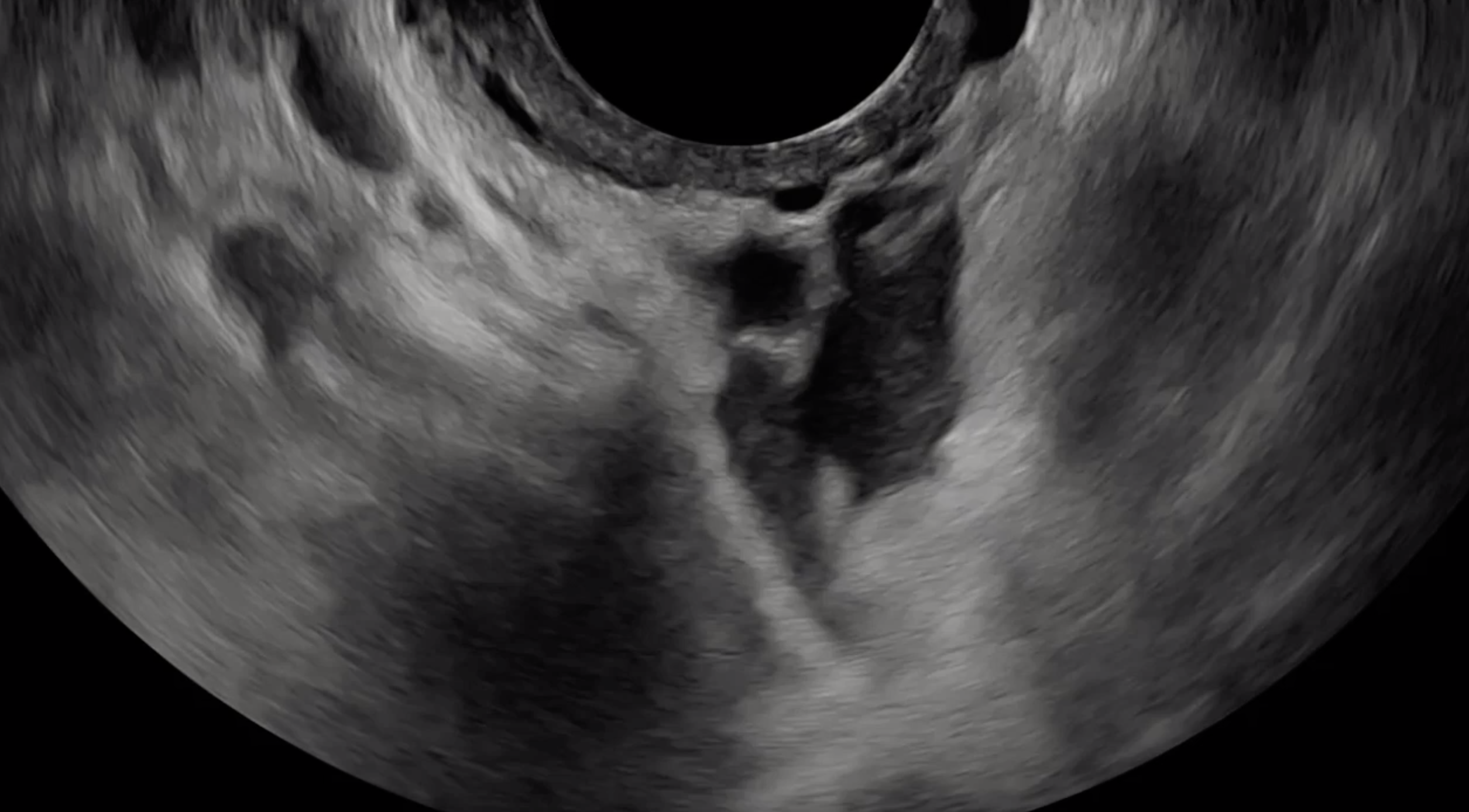 Endometriosis Ultrasound