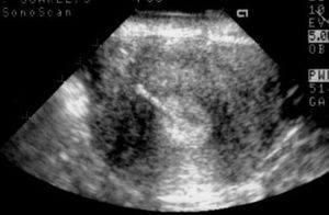 TRV Uterus IUCD Fragment post IUCD Removal