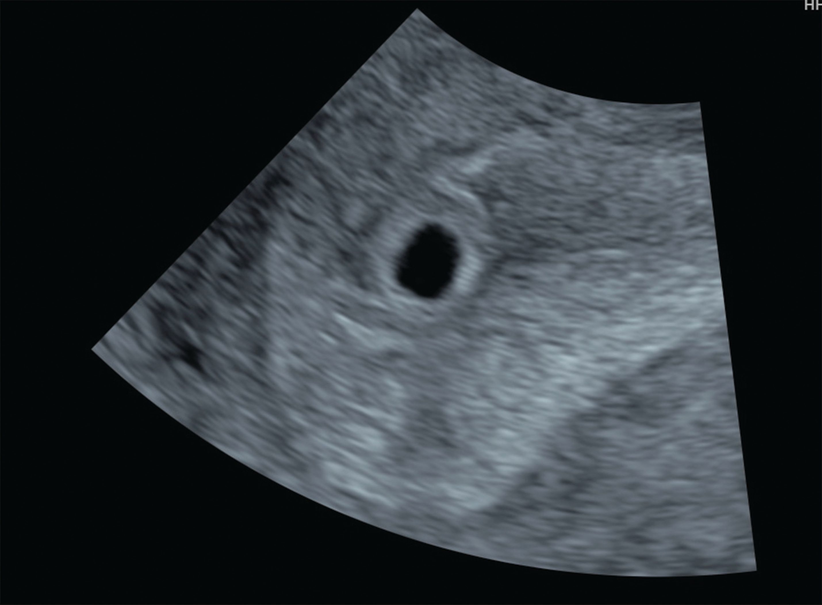 An Imaging Approach To Early Pregnancy Failure An Imaging Approach To Early Pregnancy Failure