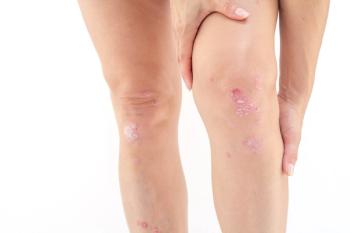Females with psoriatic arthritis, psoriasis report higher disease burden | Image Credit: © SNAB - © SNAB - stock.adobe.com.