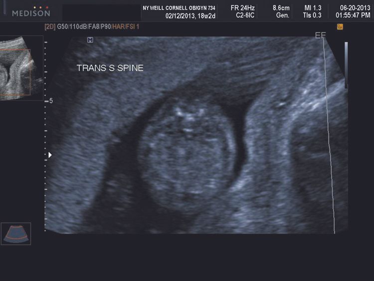 Second trimester sacral spina bifida transverse